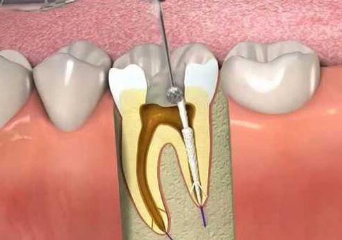 عصب کشی دندان چیست؟ مراحل عصب کشی