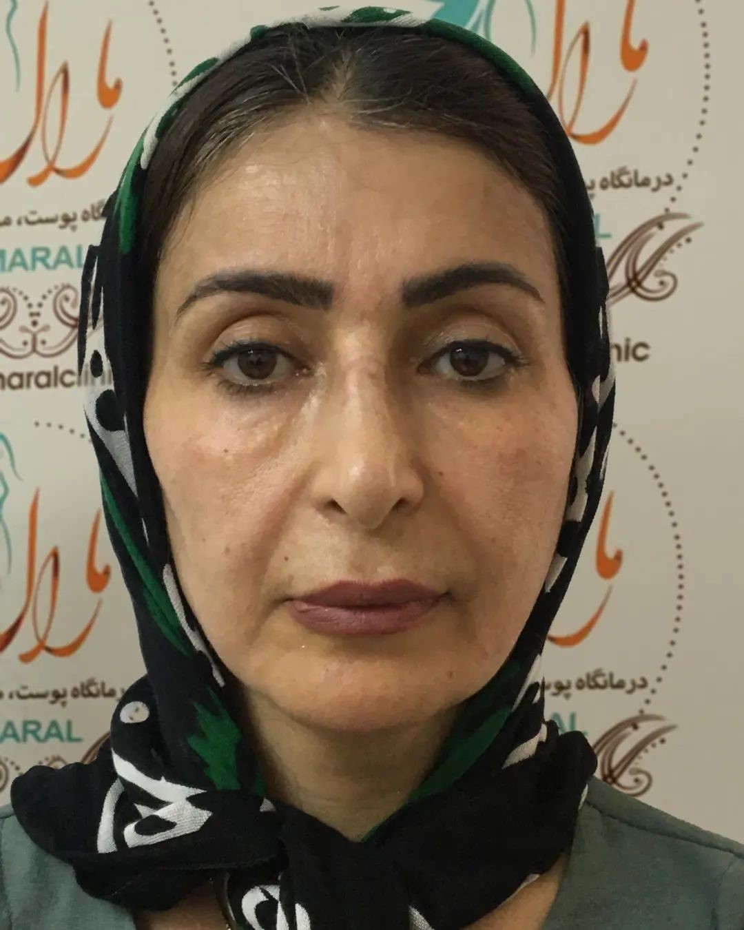بهترین جراح درمان افتادگی پلک در تهران