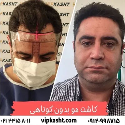 بهترین روش کاشت ریش