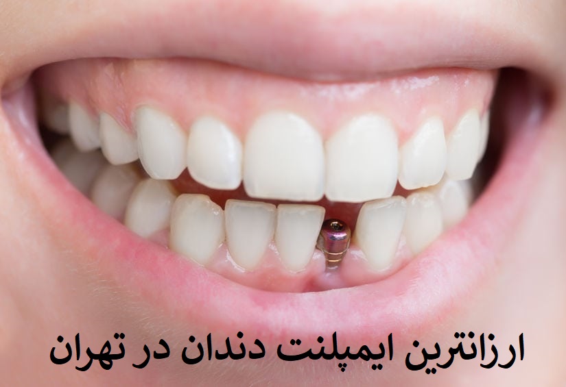ایمپلنت قسطی در تهران 100 درصد تضمینی