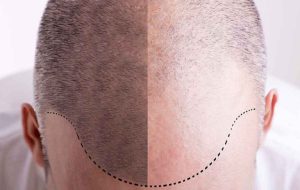 شرح کامل مهمترین مراحل کاشت مو + زمان بهبودی